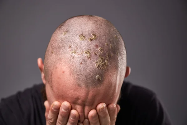 Hair & Scalp Disorders