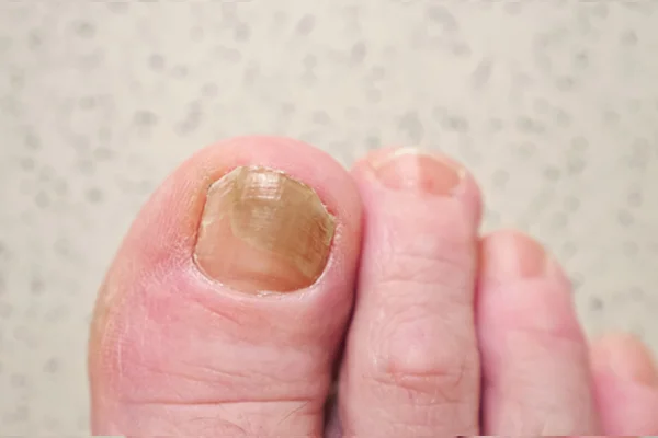 Nail Disorders