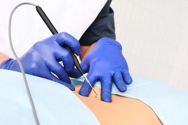 Dermatosurgical Procedures